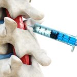 Guided epidural steroid injection in the lower spine for pain management treatment.