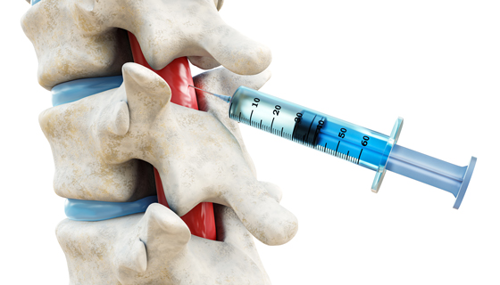 Patient receiving a lumbar epidural injection to treat sciatica and lower back pain.